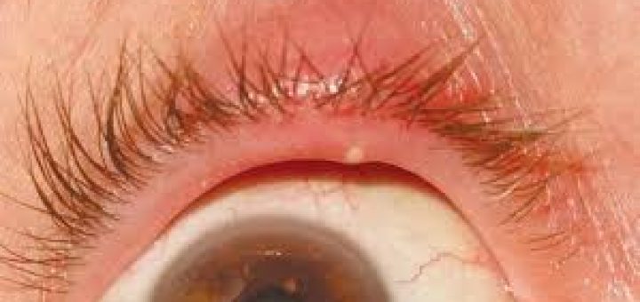 Foto de Closeup Do Olho Olho De Hordéolo Doença Oftalmológica